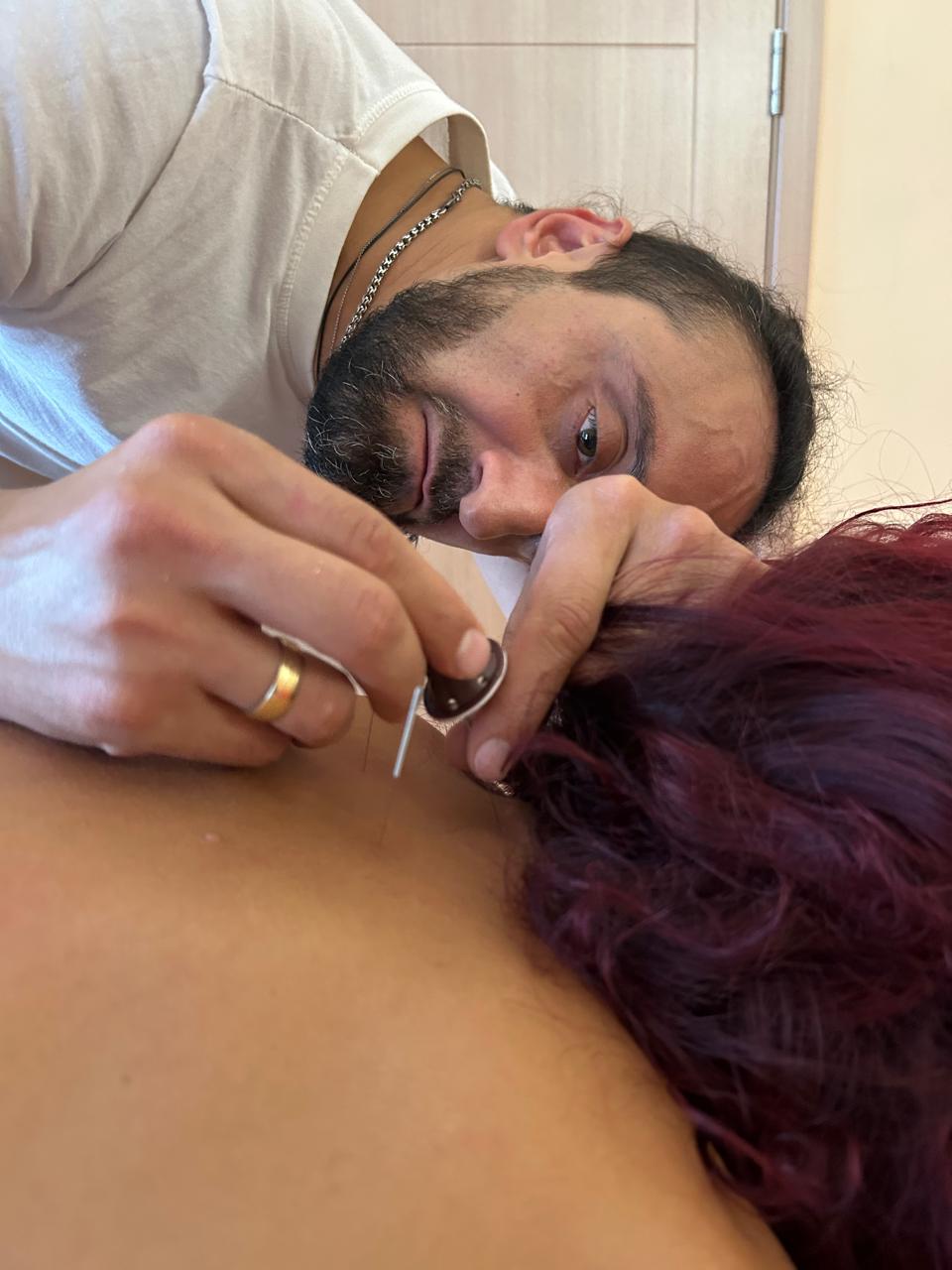 აკუპუნქტურა